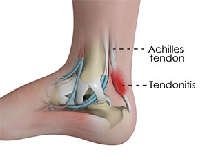 Achilles Tendinitis