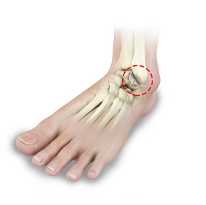 Foot and Ankle Arthritis