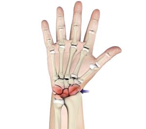 Arthritis of the Hand & Wrist