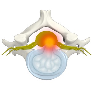 Disc Protrusion