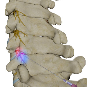 Cervical Facet Blocks