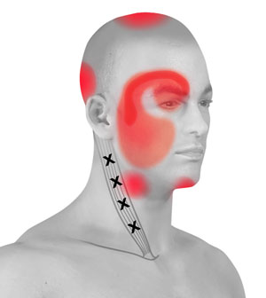 Cervicogenic Headache