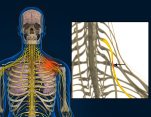 Compression of Thoracic Nerve