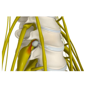 Disc Herniation