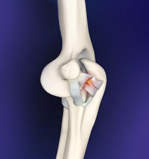 Elbow Ligament Injuries