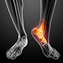 Treatment of Foot & Ankle Sports Injuries