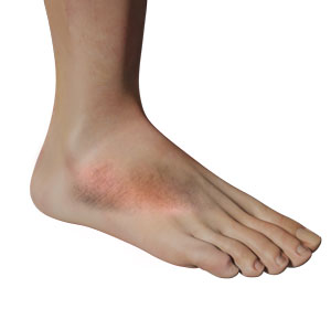 Foot Inflammation