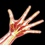 Upper Limb (Arm) Artery Disease