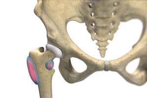 >Hip Bursitis