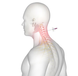 In-Office Cervical Injections