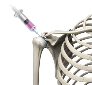 Intra-Articular Joint Injections