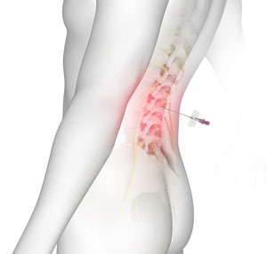 Lumbar Epidurals