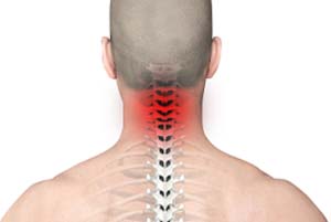  Neck Pain