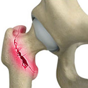 Osteoporotic Fractures