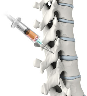 Spine Injections