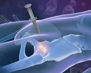 Stem Cell Therapy for Hip Injuries