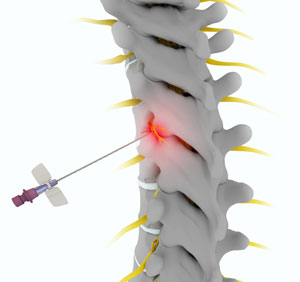 Thoracic Facet Joint Injection