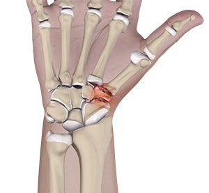 Triscaphoid Joint Arthritis