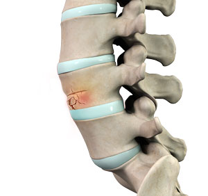 Vertebral Compression Fractures