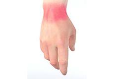 Wrist Pain