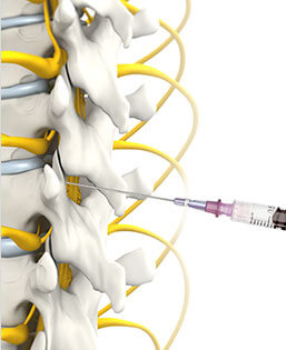 Epidural Injections