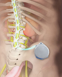 Intrathecal Pain Pump Implantation