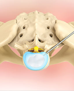 Minimally Invasive Spine Surgery