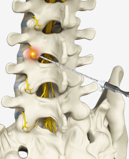 Radiofrequency Ablation