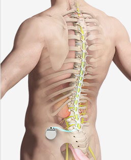 Spinal Cord Stimulation